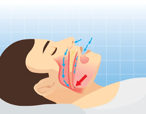 Diagram of a person’s mouth and throat while snoring 