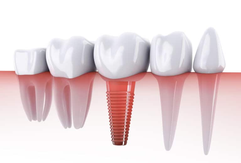 Molars and dental implants in the jaw bone. 3d render.