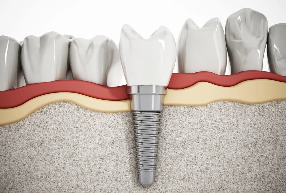 dental implant placed in the lower